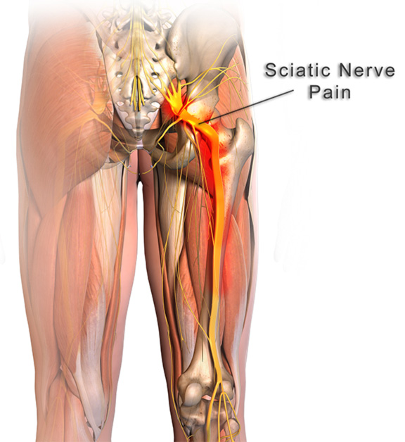 Sciatic Nerve Pain And Muscle Spasms