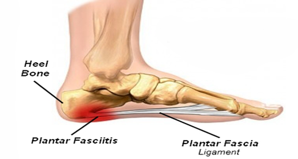 heel-pain-on-the-inside-of-the-foot-ssor-physical-therapy