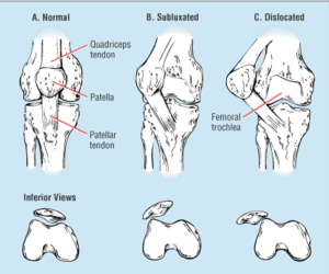 Picture of Normal, Subluxed, and Dislocated Patella