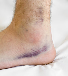 ankle sprina 270x300 Rehab after an Ankle Sprain