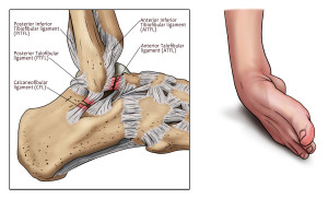 "Rolled ankle." Note the difference in the injured anatomy. It's not as "high" up as the high ankle sprain