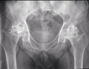 X-ray of the hips showing advanced AVN