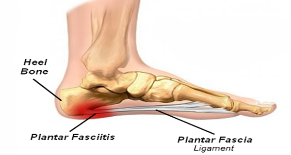 5 Stretches to Cure Plantar Fasciitis | The Iowa Clinic