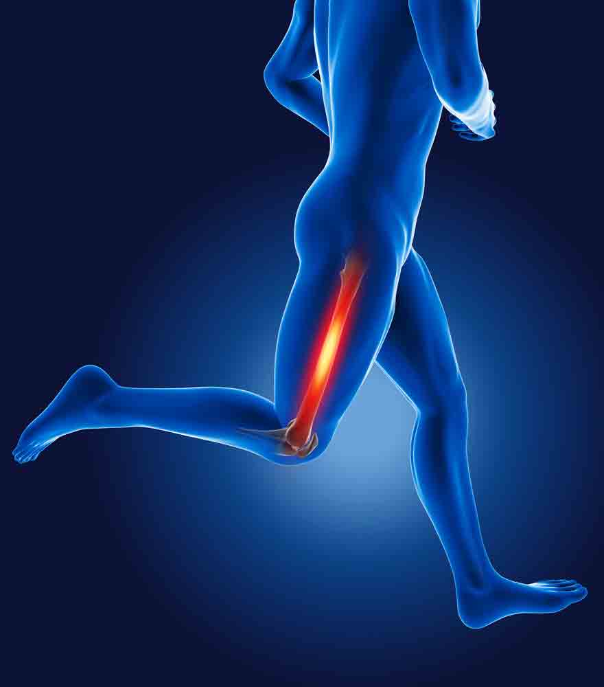 Managing IT Band Friction Syndrome running leg pain physical therapy oakland 128648288 1 managing it band friction syndrome uncategorized