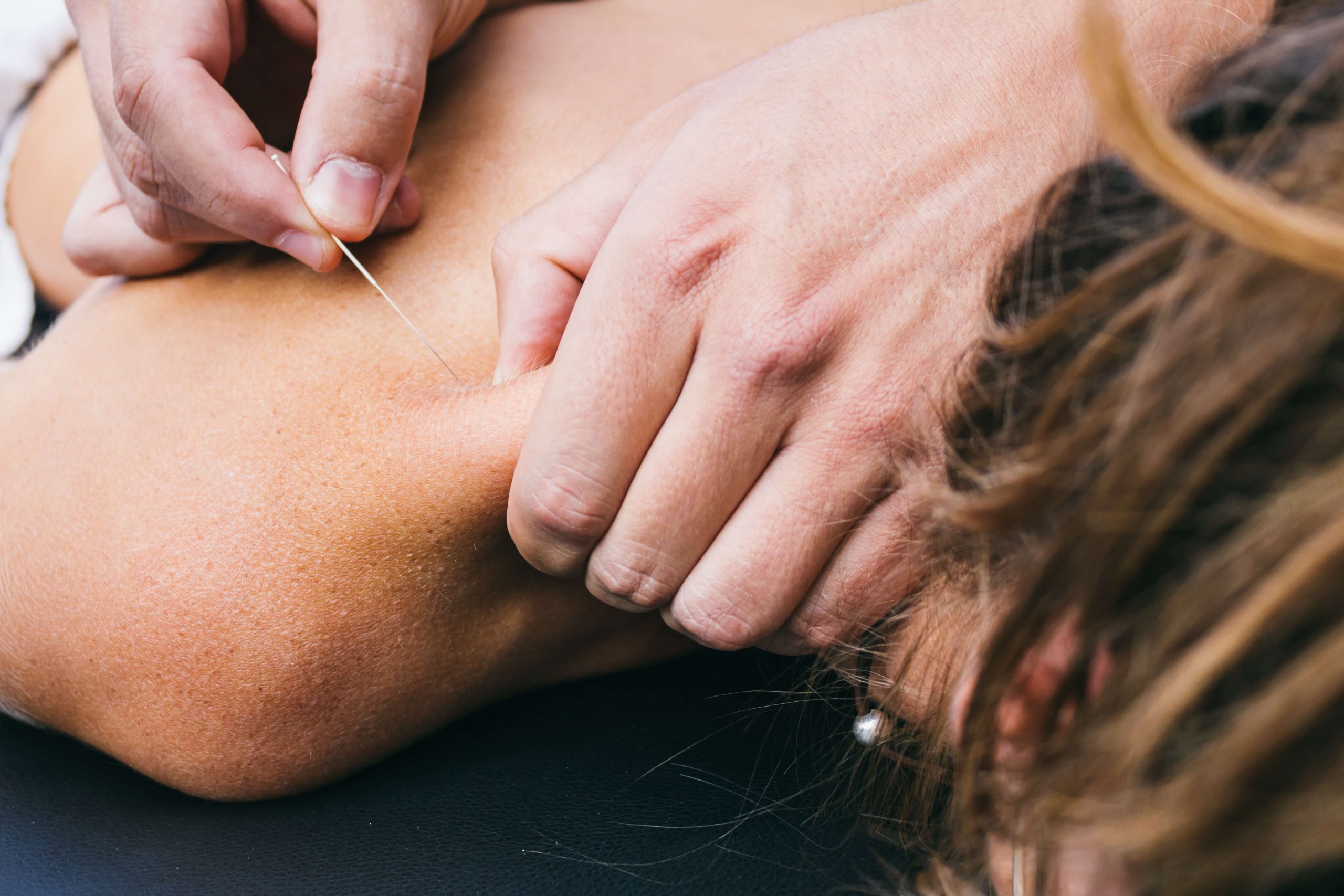 Things to Know About Dry Needling shutterstock 317136938 scaled Things to Know About Dry Needling